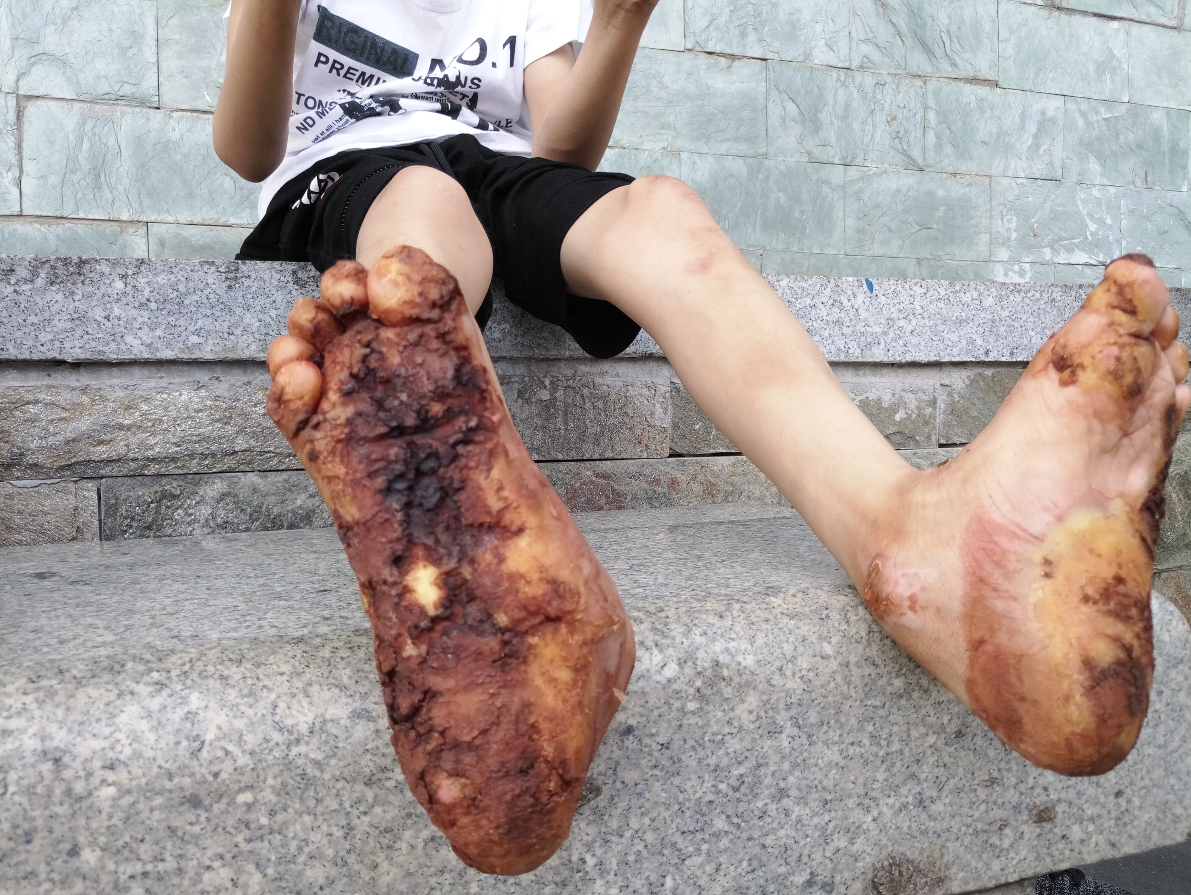 5岁脸部毛周角化症怎么治疗,2岁宝宝皮肤角化