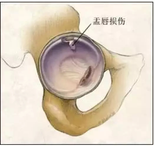 小时候青霉素打多了会影响智商吗,小时候打青霉素针导致的腿变形