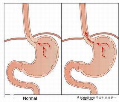 反酸咽喉炎的最佳治疗方法,咽喉反酸打嗝会好些吗