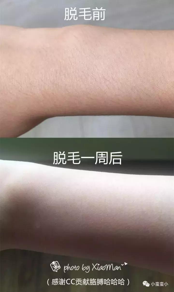 脱毛干货合集,史上最全脱毛仪