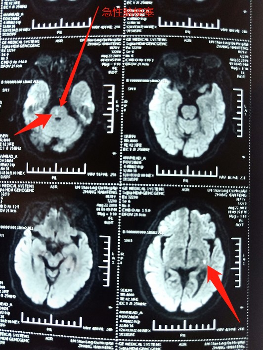 手指麻木不一定是颈椎病