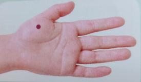 张景明小儿厌食,小儿厌食一贴灵