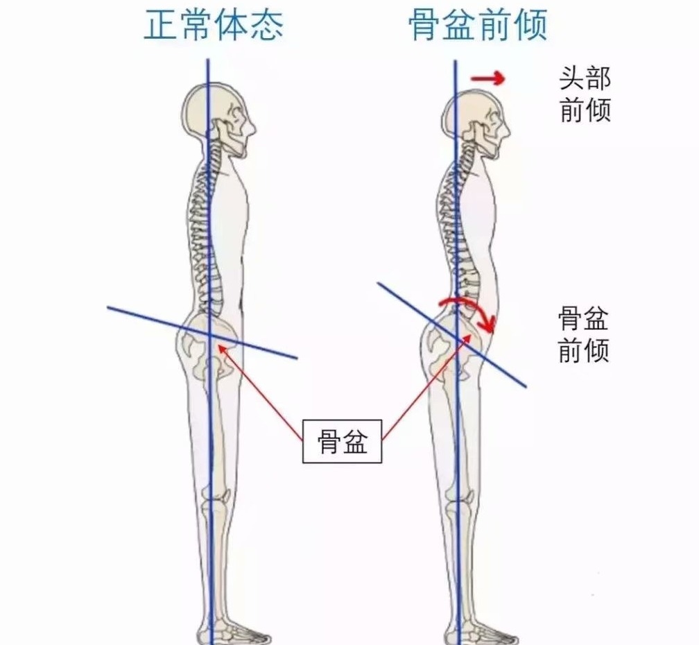 扁平足穿没有足底支撑的鞋,如何改善扁平足穿鞋的效果
