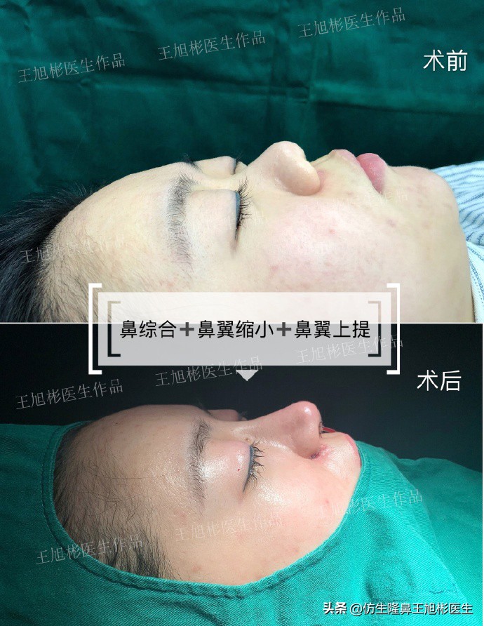 隆鼻鼻头大是失败了吗,大鼻头隆鼻手术案例