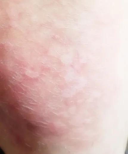 全身长满了牛皮癣属于重度吗,牛皮癣好了突然身上一堆小红疙瘩