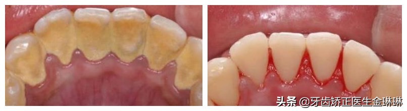 牙齿缝里有牙结石怎么才弄得掉,牙结石去临泉哪里洗牙好