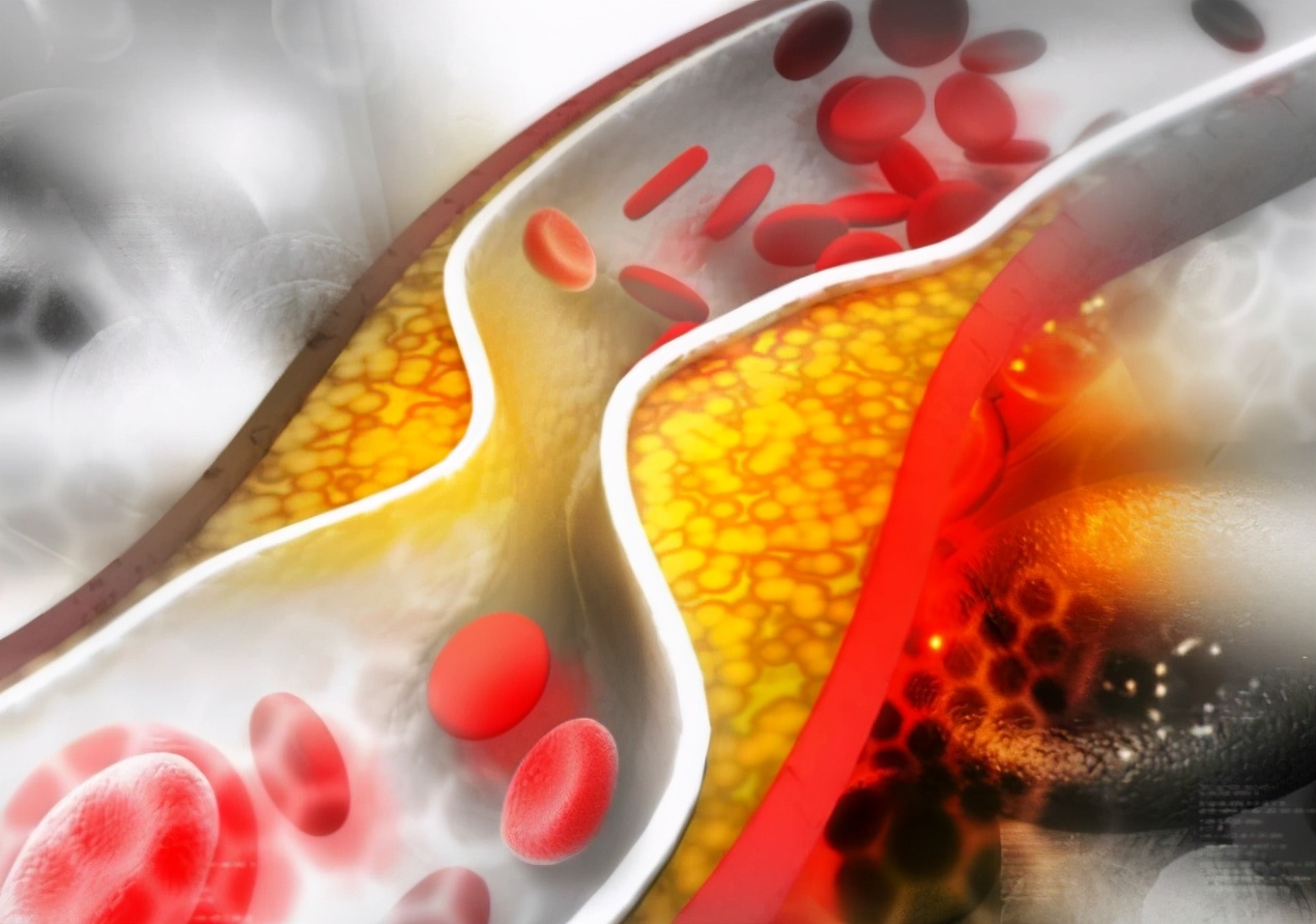 对人体健康有益的血脂是什么,血脂严格控制的好处