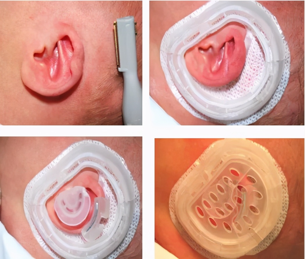 宝宝天生一对招风耳可以矫正吗,新生婴儿招风耳怎么矫正