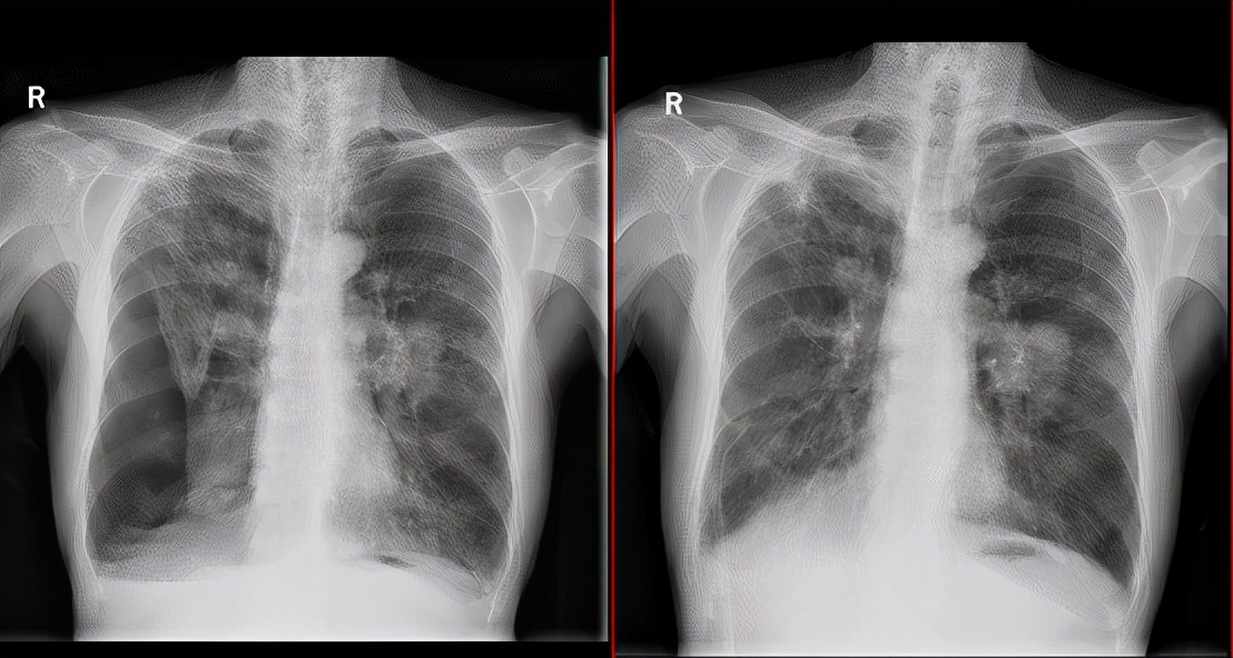 八十多岁老人气胸能好吗,老人70%气胸建议做什么手术