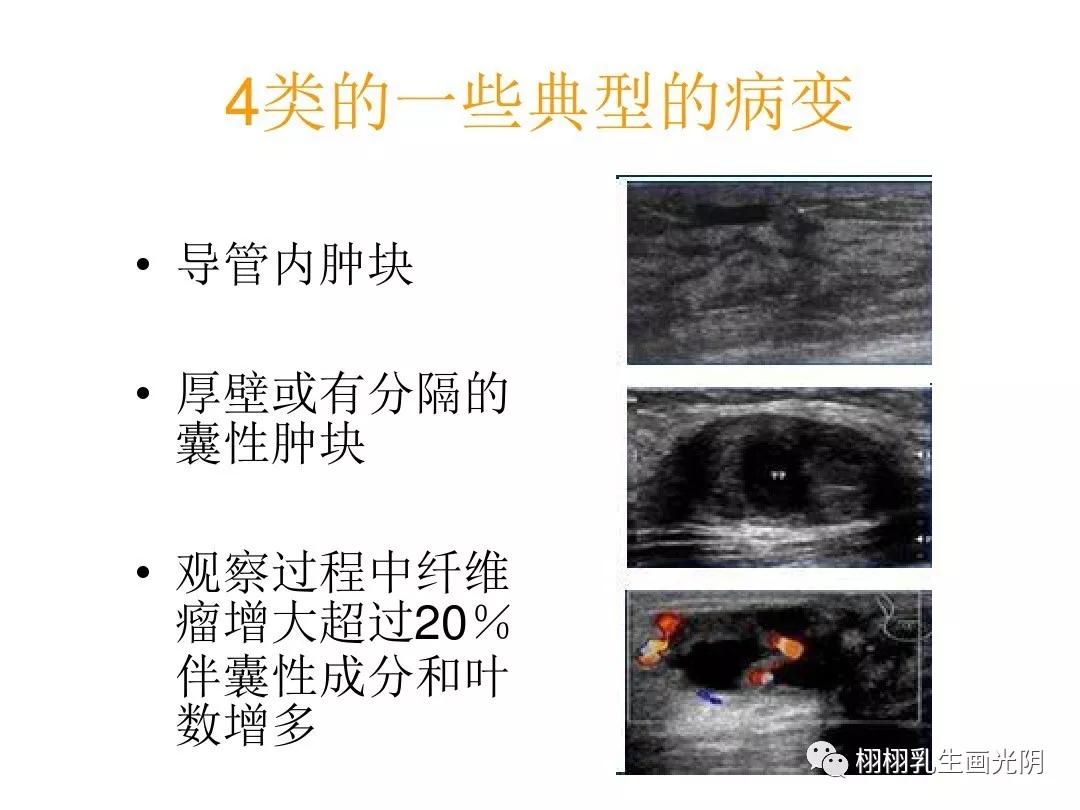 秒懂乳腺超声报告,秒懂超声系列
