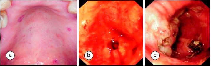 多发性硬化症和系统性硬皮病,系统性硬皮病有什么症状