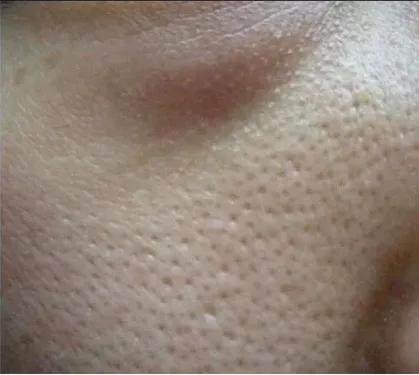 鼻子两侧毛孔粗大是什么原因,毛孔粗大原因及如何改善