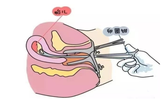 无痛人流当真不痛吗,无痛人流真的毫无痛感吗