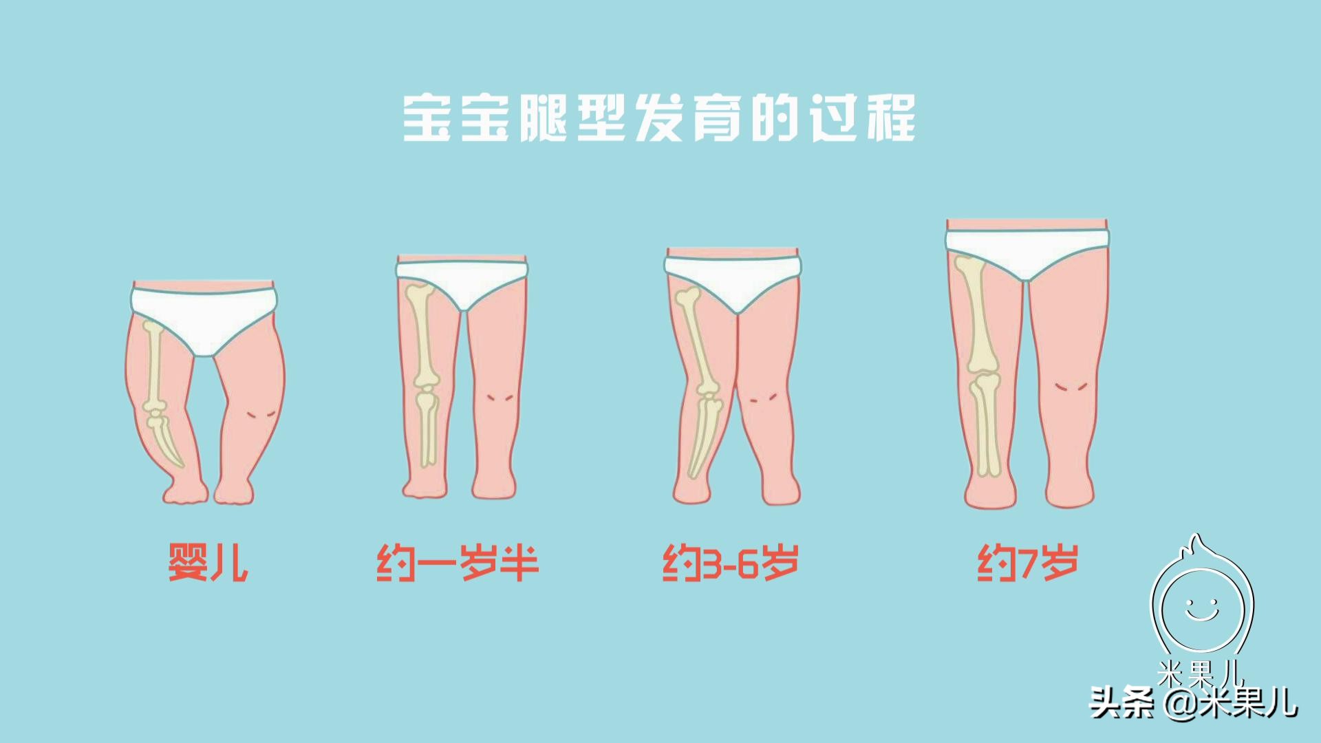 婴儿有o型腿的症状,刚出生婴儿o型腿原因及矫正方法
