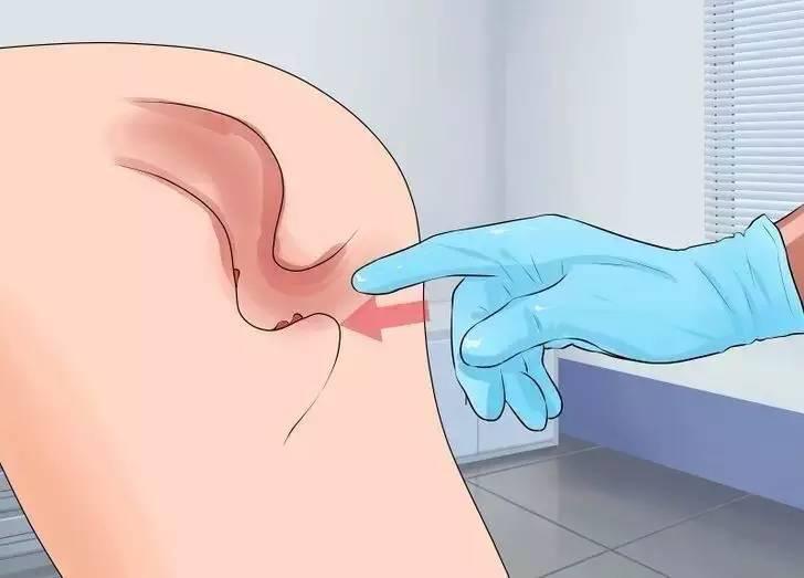 直肠指诊科普系列三,直肠指检百科