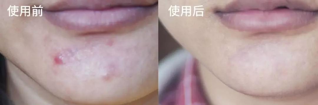 蜂胶消炎祛痘,蜂胶治疗皮癣吗