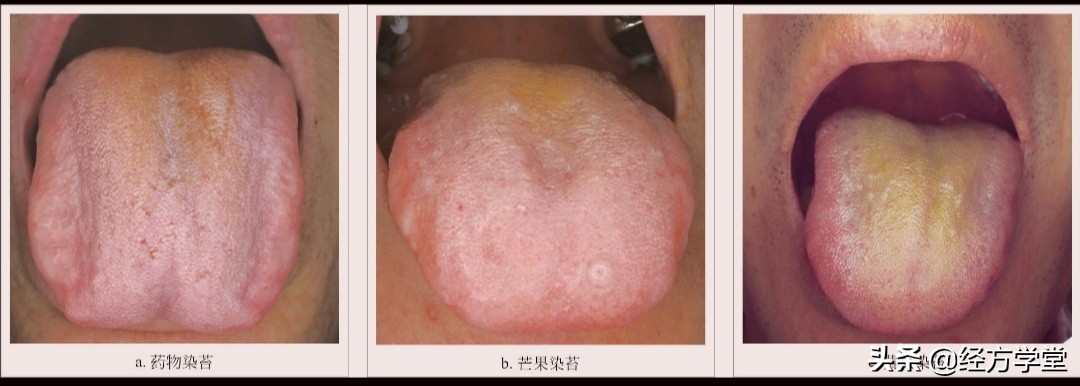 观舌养生舌诊入门一学就会,舌诊图片与经方治疗