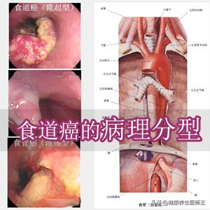 食管癌四期化疗能延长多久生命,食管癌手术后健康宣教