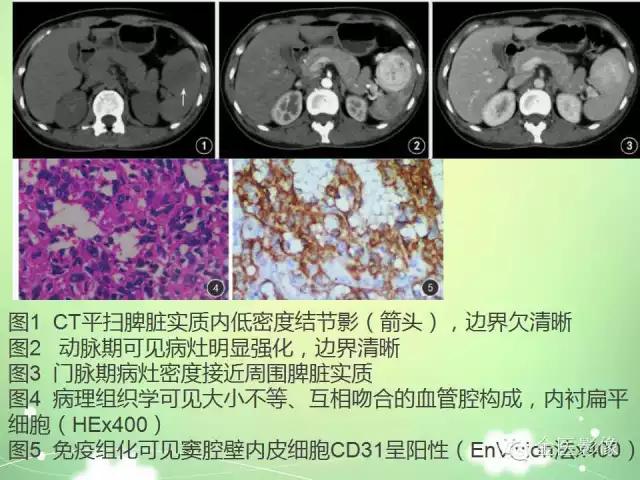 脾血管瘤中医辨证,脾血管瘤超声表现