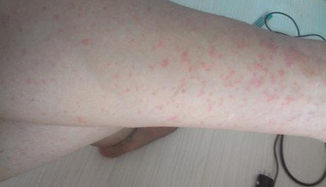 湿疹严重有什么忌口,湿疹过来人的独家秘籍