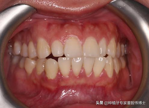 全冠修复与种植区别,全口即刻种植修复详细流程介绍