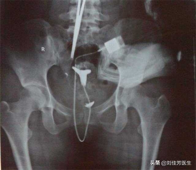 输卵管堵塞最有效的疏通方法,输卵管堵塞疏通妙招