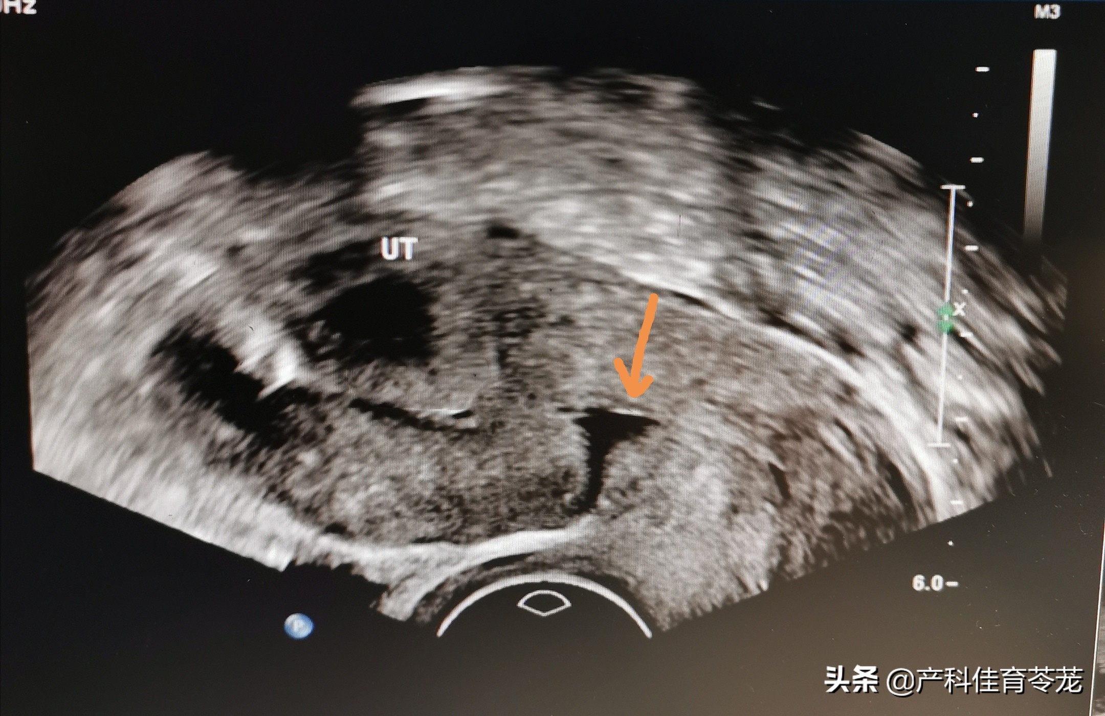 剖腹产后子宫出血是正常的吗,剖宫产术后又流血