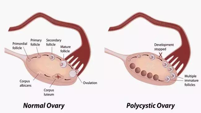 小马健身｜多囊卵巢综合征表现及预防治疗相关问题