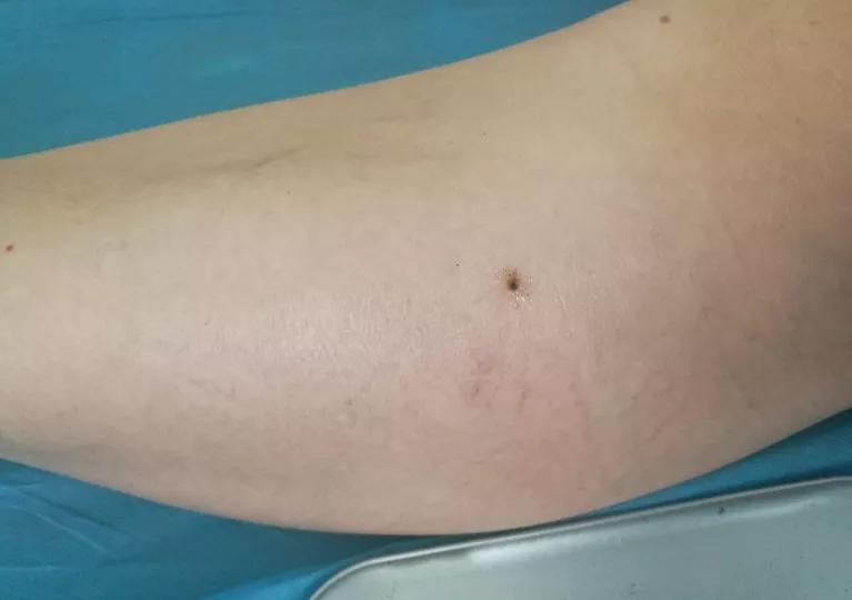 潍坊肺结节微创手术,潍坊市治疗肺部结节的中医