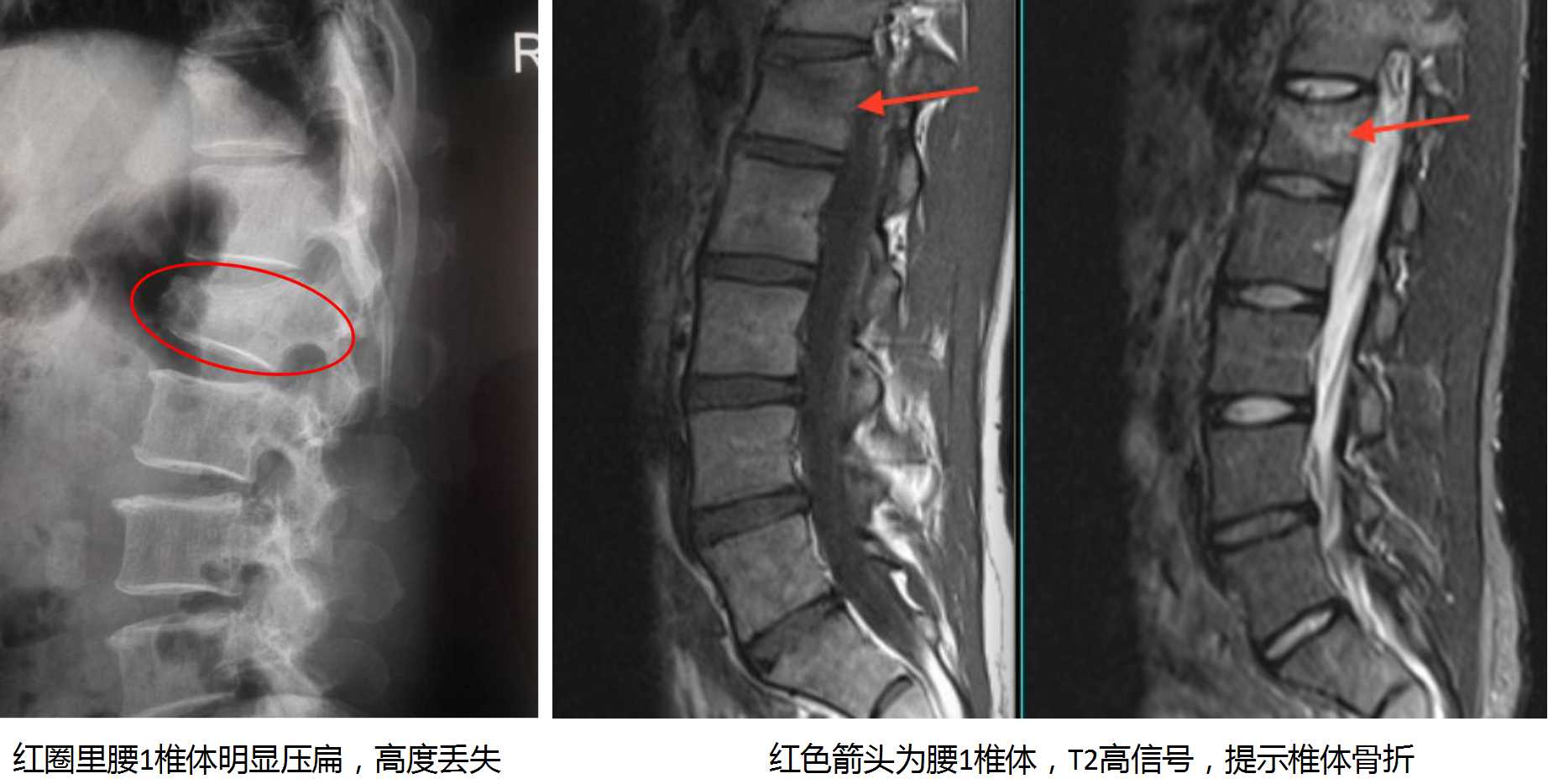 70岁老人腰骨折需要手术么,70岁老人腰椎骨折是保守还是手术