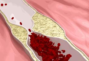为什么高血压是无形的杀手,高血压是无形杀手吗