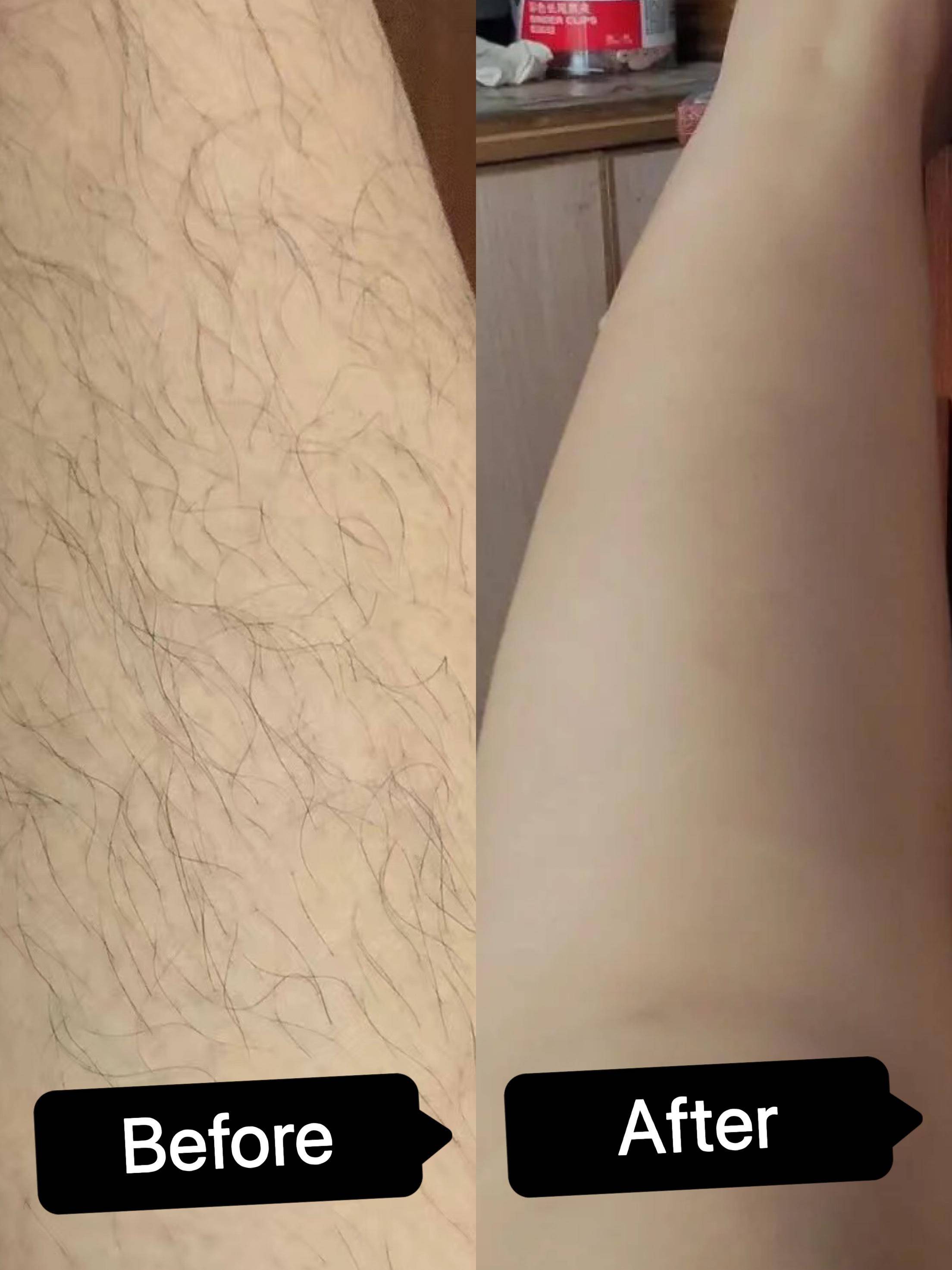 脱毛仪真实测评三个月效果,脱毛仪实测效果