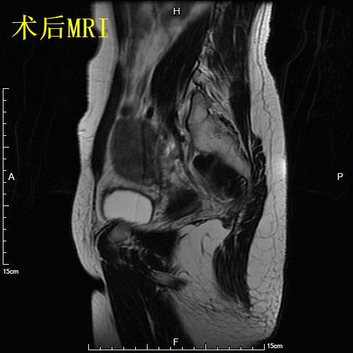 子宫肌瘤介入栓塞术排出黄水,子宫肌瘤介入消融治疗