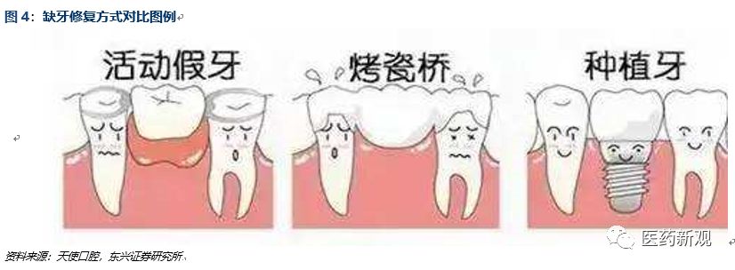 种植牙技术排行,种植牙材料行业怎么样