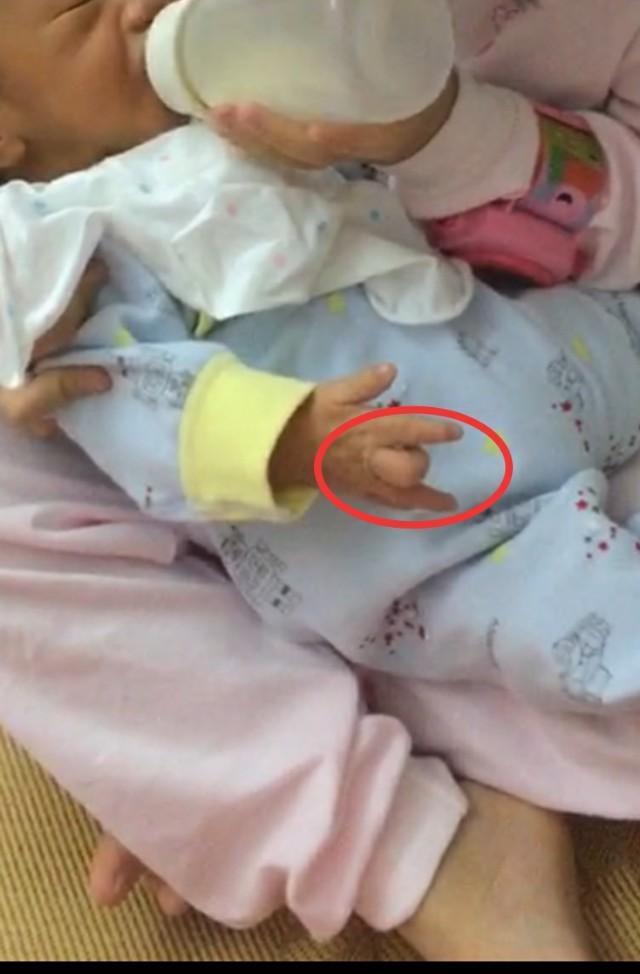 幼儿狭窄性腱鞘炎术后康复,狭窄性腱鞘炎康复训练英文