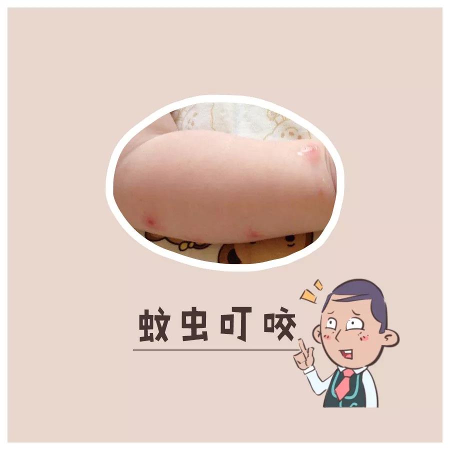 天热起痱子怎么能去根,天热痱子用什么药材治呢