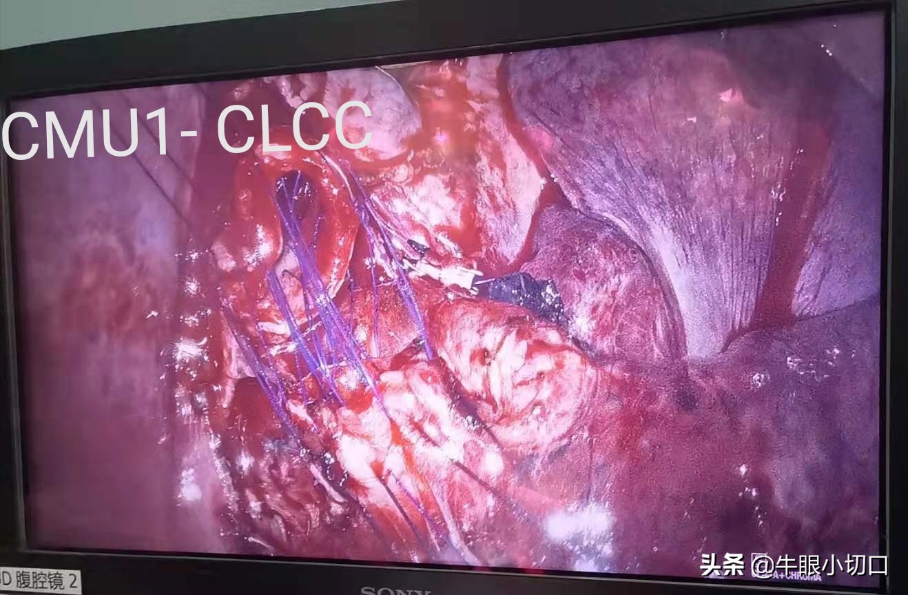 胸腔长了个小瘤子怎么办,胸腔长瘤该怎么办