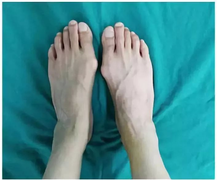 双足拇外翻需要手术吗,拇外翻矫形