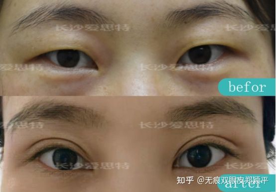 割双眼皮几毫米最好看,割双眼皮真的会好看吗