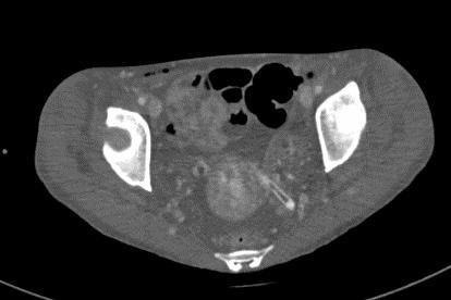 重度高碳酸血症突出表现,出现消化系统疾病的临床表现