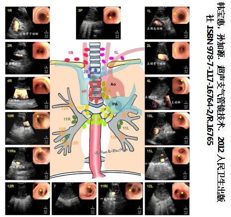 小细胞肺癌的气管镜介入治疗,导航支气管镜在肺癌诊断中的应用