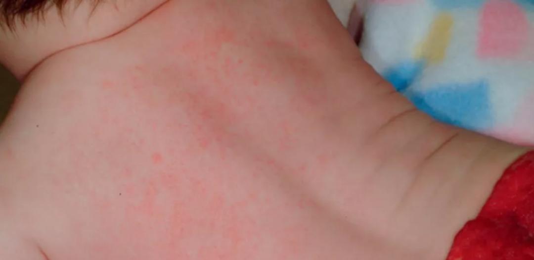 汗疱疹湿疹痱子的皮肤护理,汗疱疹和痱子怎么治