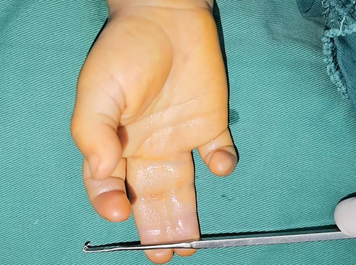 手指植皮后多久可以分指,做并指分指手术复杂吗需要植皮吗