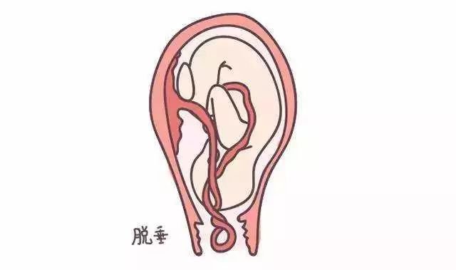 产妇脐带脱垂急救视频,产妇脐带脱垂医生全程托举救命