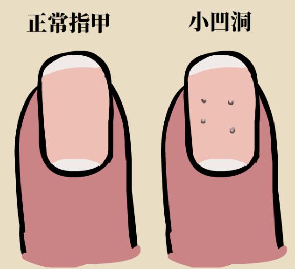 产后指甲出现小坑和凹痕,每个指甲中间都出现一条横凹痕