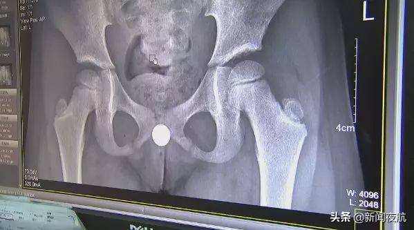 小女孩*体下**塞入异物流血不止！隔了几天走路都不对劲了