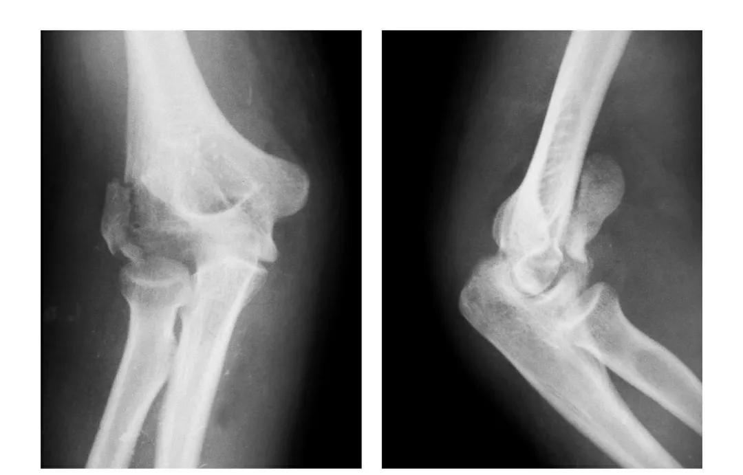 青少年肘部损伤最常见的是,肘部桡神经损伤的临床表现