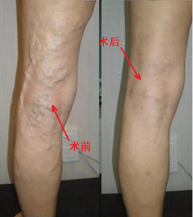 看过来,看过来!静脉曲张与静脉血栓到底有什么区别和联系?