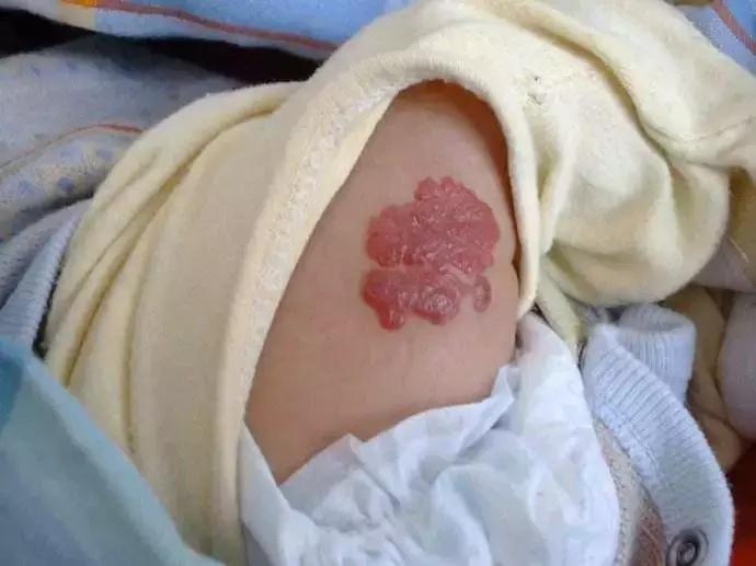 新生儿皮肤问题怎么解决,家有新生儿怎么办