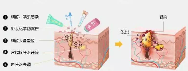 孩子长痘痘抹什么药膏保湿,小孩长痘痘怎么治疗最好8岁